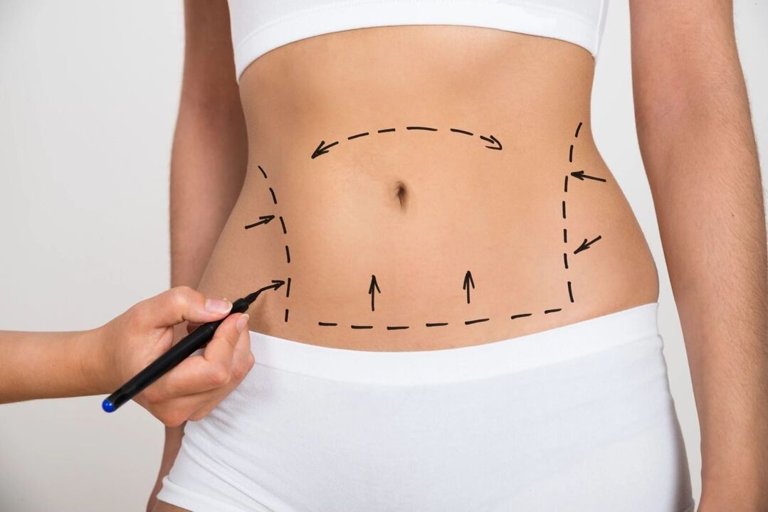 Marcaj pe abdomen înainte de liposucție, corectând silueta